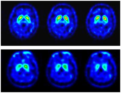 Cortical excitability in patients with REM sleep behavior disorder with abnormal TRODAT-1 SPECT scan: an insight into prodromal Parkinson’s disease